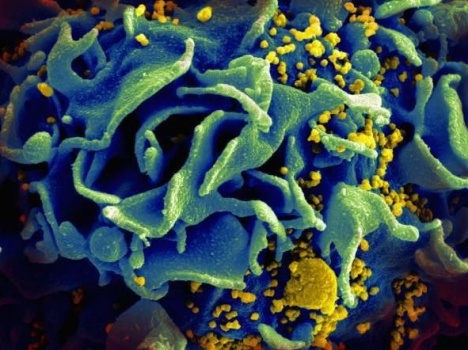 HIV particles, yellow, infect an immune cell, blue.
