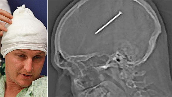 Nail in the brain