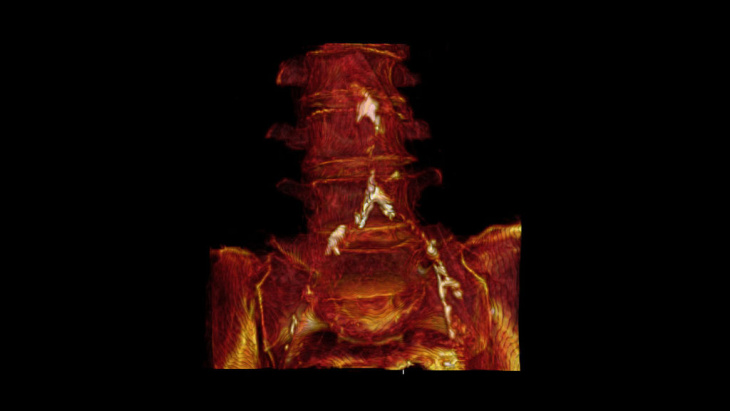 A 3-D reconstruction of Mummy 38's CT scans shows calcification in her aorta and iliac arteries.