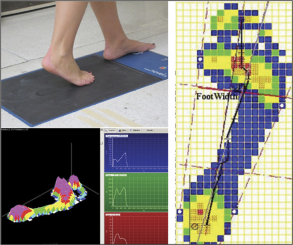 FIGURE 2. Measurements of arch function. Pedobarograph (top left), foot pressures during walking (bottom left), and center of pressure excursion (black line on the right)."