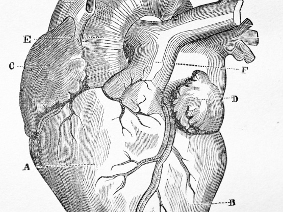 There's been great progress in treating heart disease, but it remains the top killer in the U.S.