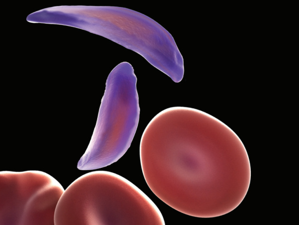 Red blood cells are normally shaped like doughnuts, but sickle cells (purple) are flattened and clump together.