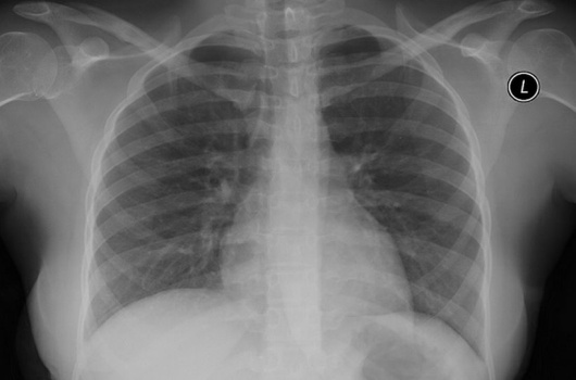 lungs xray