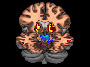 This composite image of brain scans shows two traits of a highly impulsive individual. The cool colors in the midbrain are indicative of a decrease in dopamine receptor levels while the warm colors show elevated levels of dopamine in a different part of the brain called the striatum.