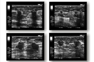 Ultrasound images show breast cancer; the depression that follows for many patients is harder to track. UCLA and Kaiser Permanente have secured a grant to study possible connections between the two conditions over five years.