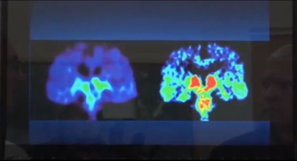 UCLA brain injury study