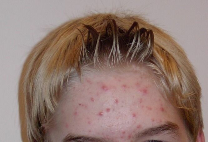 Acne Forehead