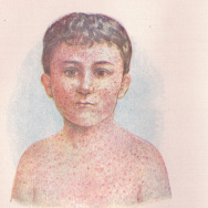 Measles illustration vintage