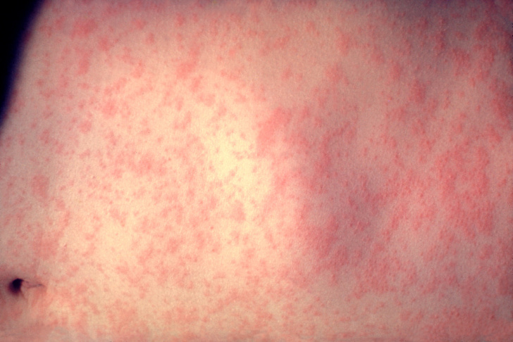 measles infection