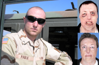Army specialist Joey Paulk Army specialist Joey Paulk before, during and after his reconstructive surgery.