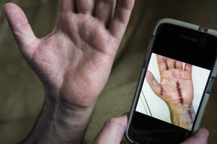 Mark Eberley, 48, shows his scar from his hand surgery after carpel tunnel syndrome left him unable to continue work at the Tesla factory in Fremont, California. Eberley says his longest stretch of working 12-hour shifts was 29 days straight. Mark Eberley, 48, shows his scar from his hand surgery after carpel tunnel syndrome left him unable to continue work at the Tesla factory in Fremont, California. Eberley says his longest stretch of working 12-hour shifts was 29 days straight.