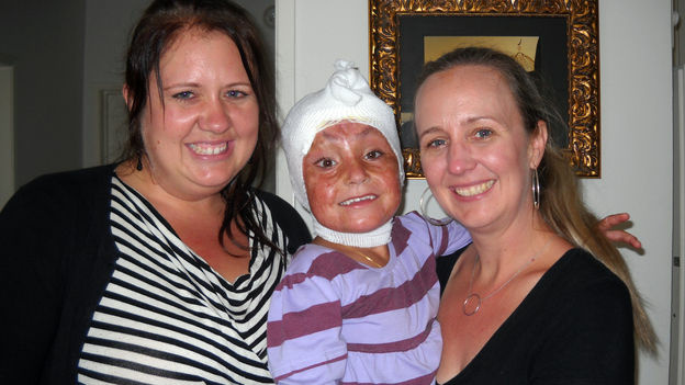 Arefa with her host family, sisters Jami Valentine (left) and Staci Freeman. Doctors in the U.S. have been treating Arefa's third-degree burns, and also performed skin-graft surgery for the top of her head. Each morning still requires a fresh dressing.