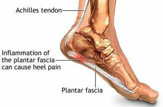 Inflammation of the plantar fascia in the foot causes heel pain.