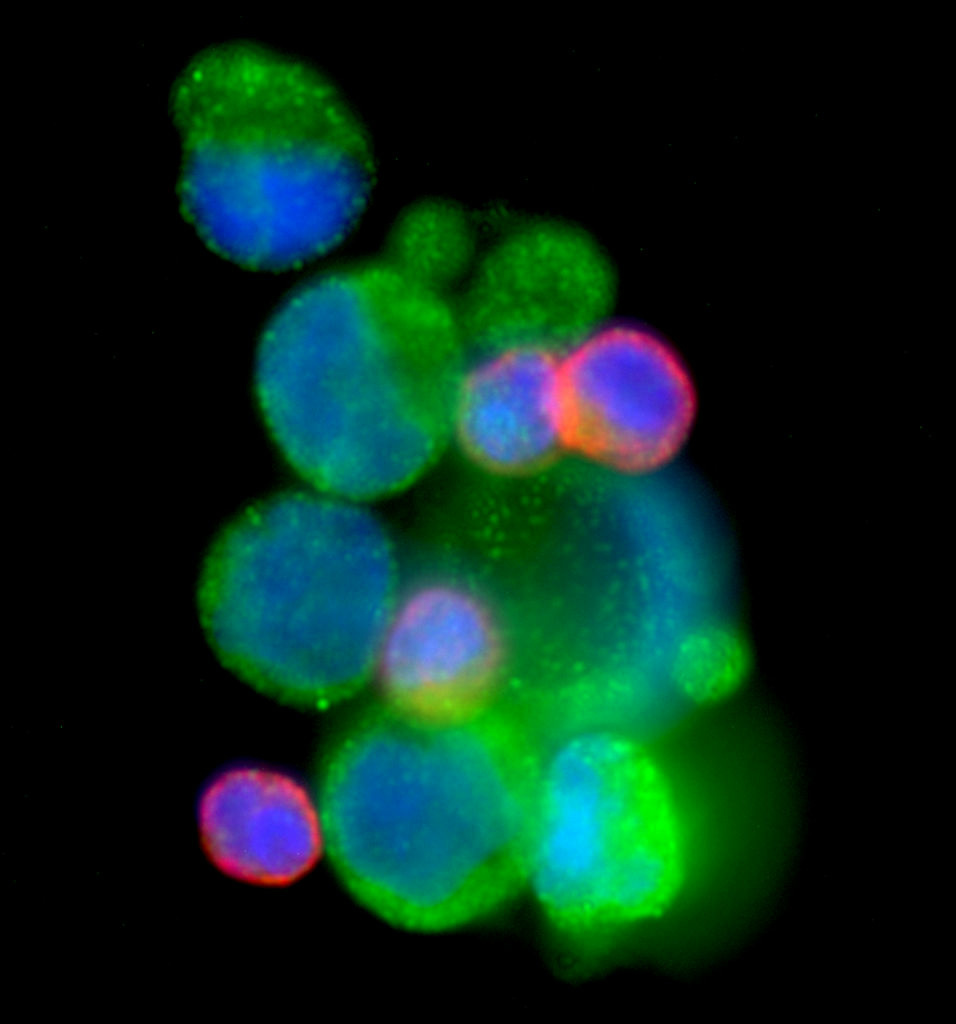 This undated image provided by PNAS Early Edition shows a circulating tumor cell cluster isolated using the HB-Chip from the blood of a patient with metastatic prostate cancer.