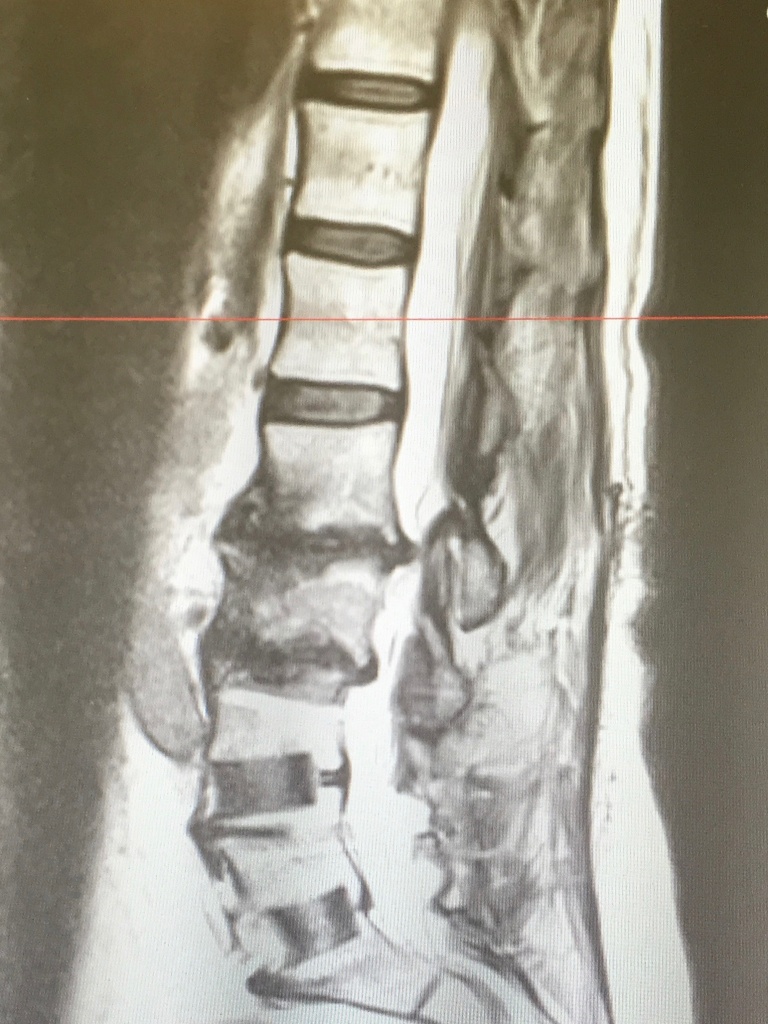 MRI of degenerative disc disease An MRI showing Jan Curtis's damaged spine. Curtis suffered chronic pain for more than a decade. She had surgery for degenerative disc disease in 2017.