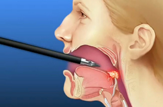 Doctors are treating sleep apnea with a type of robotic surgery typically used to remove cancerous tumors at the back of the throat.