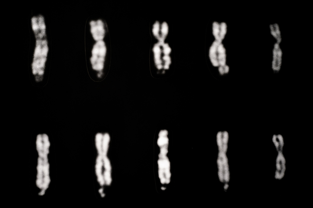 Audio: An Alzheimer's Drug May Boost Cognition In People With Fragile X Syndrome - Vimarsana News