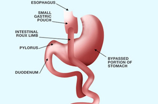 Gastric bypass procedures (GBP) divide the stomach into a small "gastric" pouch and a much larger, lower "bypassed" pouch. The operation makes the stomach smaller and makes the patient feel full faster.