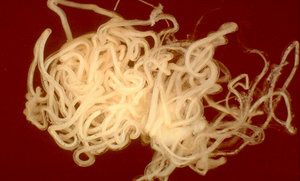 The adult form of the O. volvulus worm, which causes river blindness and may also be responsible for nodding syndrome. The adult form of the O. volvulus worm, which causes river blindness and may also be responsible for nodding syndrome.