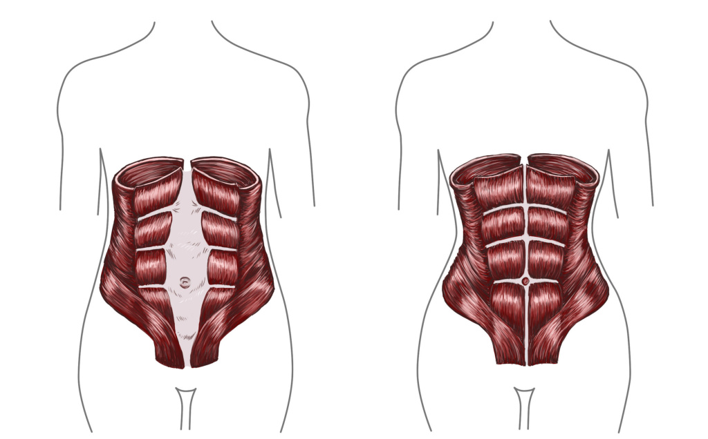 Mummy Tummy During pregnancy, the abdominal muscles responsible for a